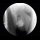Scrotal hernia, cecum in scrotal hernia: RF - Fluoroscopy