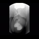 Scrotal hernia, cecum in scrotal hernia: RF - Fluoroscopy