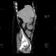 IPMN, intrapapillary mucinous neoplasm, central type, colitis: CT - Computed tomography