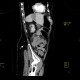 IPMN, intrapapillary mucinous neoplasm, central type, colitis: CT - Computed tomography
