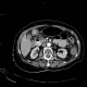 IPMN, intrapapillary mucinous neoplasm, central type, colitis: CT - Computed tomography