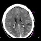 Brain metastasis: CT - Computed tomography