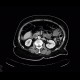 Ileus, bowel ischemia: CT - Computed tomography