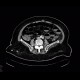 Ileus, bowel ischemia: CT - Computed tomography