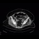 Ileus, bowel ischemia: CT - Computed tomography