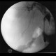 Cholangoitis, acute, perioperative cholangiography: RF - Fluoroscopy