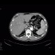 Cholangiocellular carcinoma: CT - Computed tomography