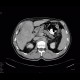 Cholangiocellular carcinoma: CT - Computed tomography