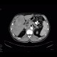 Cholangiocellular carcinoma: CT - Computed tomography