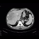 Cholangiocellular carcinoma: CT - Computed tomography