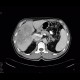 Cholangiocellular carcinoma: CT - Computed tomography