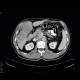 Cholangiocellular carcinoma: CT - Computed tomography