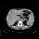 Cholangiocellular carcinoma: CT - Computed tomography