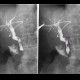 Cholangiography, T-drain, choledocholithiasis: RF - Fluoroscopy