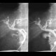 Cholangiography, hepaticolithiasis: RF - Fluoroscopy