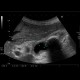 Chronic cholecystitis, cholecystolithiasis: US - Ultrasound