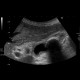 Chronic cholecystitis, cholecystolithiasis: US - Ultrasound