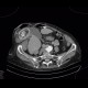 Gallstones, cholecystolithiasis, cholecystitis, incisional hernia: CT - Computed tomography
