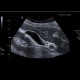 Cholecystolithisasis, gallstones: US - Ultrasound