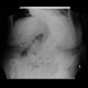 Cholecystostomy, acute cholecystitis: X-ray - Plain radiograph