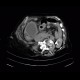 Cholecystostomy, acute cholecystitis: CT - Computed tomography