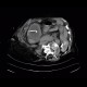 Cholecystostomy, acute cholecystitis: CT - Computed tomography