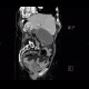Cholecystostomy, acute cholecystitis: CT - Computed tomography