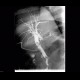 Choledocholithiasis, T-drain: RF - Fluoroscopy