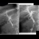 Choledocholithiasis, T-drain: RF - Fluoroscopy