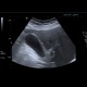 Cholesterolosis of gallbladder: US - Ultrasound