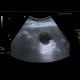 Cholesterolosis of gallbladder: US - Ultrasound