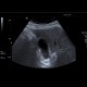 Cholesterolosis of gallbladder: US - Ultrasound