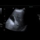 Cholesterolosis of gallbladder: US - Ultrasound