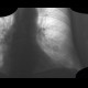 Chondrohamartoma of lingula, lung: X-ray - Plain radiograph