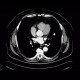 Chondrohamartoma of lingula, lung: CT - Computed tomography