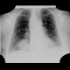 Chondroma of lung, gigantic: X-ray - Plain radiograph