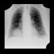 Chondroma of lung, gigantic: X-ray - Plain radiograph