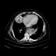 Chondroma of lung, gigantic: CT - Computed tomography