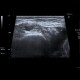 Chondromatosis of knee joint, joint effusion: US - Ultrasound