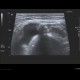 Chondromatosis of knee joint, joint effusion: US - Ultrasound