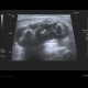 Chondromatosis of knee joint, joint effusion: US - Ultrasound