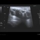 Chondromatosis of knee joint, joint effusion: US - Ultrasound