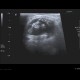 Chondromatosis of knee joint, joint effusion: US - Ultrasound