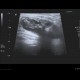 Chondromatosis of knee joint, joint effusion: US - Ultrasound