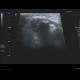 Chondromatosis of knee joint, joint effusion: US - Ultrasound