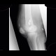 Chondromatosis of knee joint, effusion, fracture of femur, osteosynthesis: X-ray - Plain radiograph