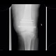 Chondromatosis of knee joint, effusion, fracture of femur, osteosynthesis: X-ray - Plain radiograph