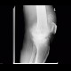 Chondromatosis, gonarthrosis: X-ray - Plain radiograph