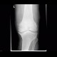 Chondromatosis, gonarthrosis: X-ray - Plain radiograph