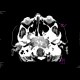 Chordoma: CT - Computed tomography